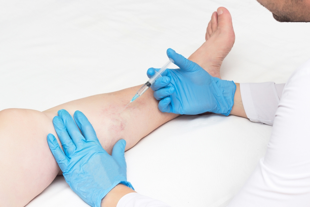 Comparing Varicose Veins Treatment Options